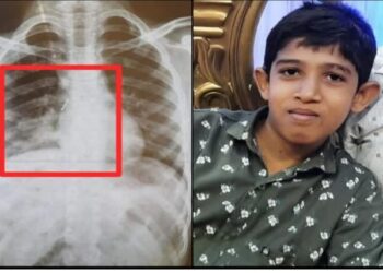 ಮಂಗಳೂರು: ಬಾಲಕನ ಶ್ವಾಸಕೋಶದೊಳಗಿದ್ದ ಗುಂಡುಸೂಜಿಯನ್ನು ಯಶಸ್ವಿಯಾಗಿ ಹೊರತೆಗೆದ ವೈದ್ಯರು