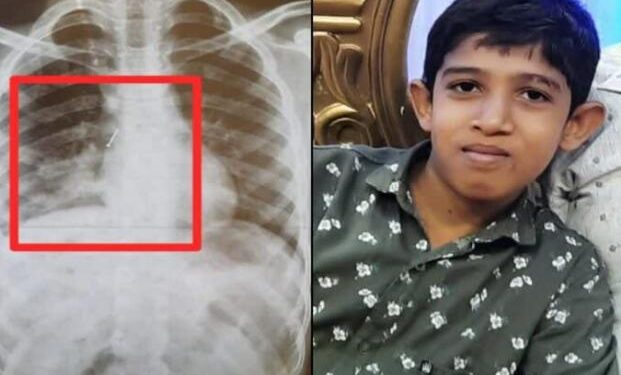ಮಂಗಳೂರು: ಬಾಲಕನ ಶ್ವಾಸಕೋಶದೊಳಗಿದ್ದ ಗುಂಡುಸೂಜಿಯನ್ನು ಯಶಸ್ವಿಯಾಗಿ ಹೊರತೆಗೆದ ವೈದ್ಯರು