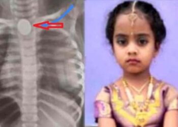 ಐದು ರೂಪಾಯಿ ನಾಣ್ಯ ನುಂಗಿದ ಮಗು ಸಾವು:; ಮನೆಯ ‘ಖುಷಿ’ ಯನ್ನೇ ದೂರ ಮಾಡಿತು ಐದು ರೂಪಾಯಿ ನಾಣ್ಯ