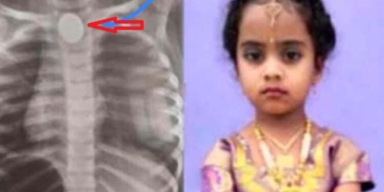 ಐದು ರೂಪಾಯಿ ನಾಣ್ಯ ನುಂಗಿದ ಮಗು ಸಾವು:; ಮನೆಯ ‘ಖುಷಿ’ ಯನ್ನೇ ದೂರ ಮಾಡಿತು ಐದು ರೂಪಾಯಿ ನಾಣ್ಯ