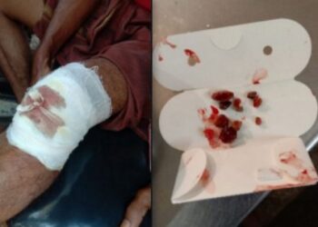 ಕಡಬ: ಗಾಯದ ಒಳಗಡೆ ಕಲ್ಲುಗಳಿದ್ದರೂ ಶುಚಿಗೊಳಿಸದೆ ಹೊಲಿಗೆ ಹಾಕಿದ ಸಿಬ್ಬಂದಿ: ಸಮುದಾಯ ಆಸ್ಪತ್ರೆಯ ಸಿಬ್ಬಂದಿಯ ಎಡವಟ್ಟಿನಿಂದಾಗಿ ಗಾಯ ಉಲ್ಬಣ: ಶಸ್ತ್ರ ಚಿಕಿತ್ಸೆ..!!