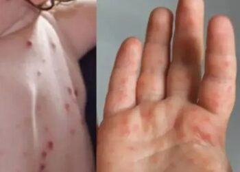 ‘ಟೊಮೆಟೋ ಜ್ವರ’: ಕರ್ನಾಟಕ-ಕೇರಳ ಗಡಿಯಲ್ಲಿ ಕಟ್ಟೆಚ್ಚರ..!!