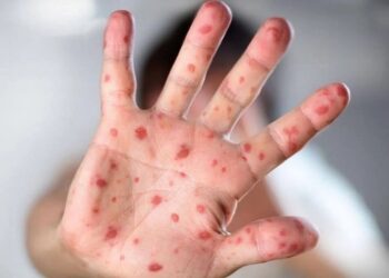 ಭಾರತದಲ್ಲಿ ಮೊದಲ ಮಂಕಿಪಾಕ್ಸ್ ಪ್ರಕರಣ ಪತ್ತೆ: ಕೇರಳದ ವ್ಯಕ್ತಿಯೋರ್ವನಲ್ಲಿ ಕಾಣಿಸಿಕೊಂಡ ಸೋಂಕು