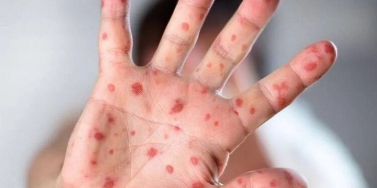 ಭಾರತದಲ್ಲಿ ಮೊದಲ ಮಂಕಿಪಾಕ್ಸ್ ಪ್ರಕರಣ ಪತ್ತೆ: ಕೇರಳದ ವ್ಯಕ್ತಿಯೋರ್ವನಲ್ಲಿ ಕಾಣಿಸಿಕೊಂಡ ಸೋಂಕು