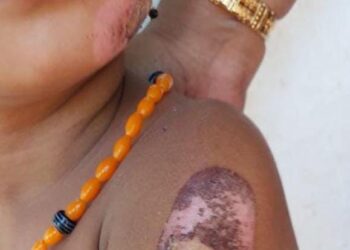 ಸುಳ್ಯ: ಮಗುವಿಗೆ ಬರೆ ಹಾಕಿದ ತಾಯಿ: ಮಗುವನ್ನು ಆಸ್ಪತ್ರೆಗೆ ದಾಖಲಿಸಿದ ಸಿ.ಡಿ.ಪಿ.ಒ..!!