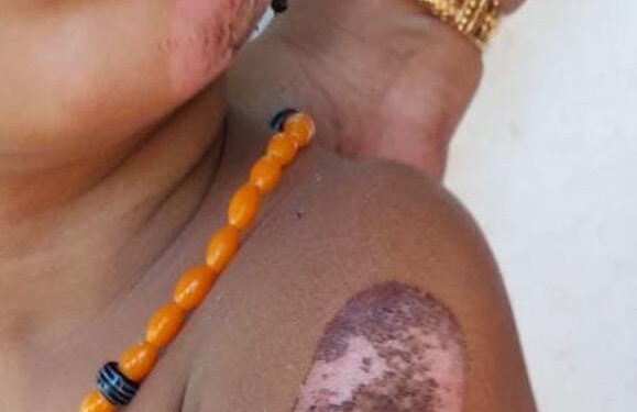 ಸುಳ್ಯ: ಮಗುವಿಗೆ ಬರೆ ಹಾಕಿದ ತಾಯಿ: ಮಗುವನ್ನು ಆಸ್ಪತ್ರೆಗೆ ದಾಖಲಿಸಿದ ಸಿ.ಡಿ.ಪಿ.ಒ..!!