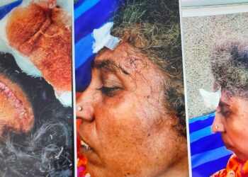 ಜಮೀನು ವಿಚಾರವಾಗಿ ಜಿ. ಪಂ. ಮಾಜಿ ಸದಸ್ಯನಿಂದ ಮಹಿಳೆಯ ಮೇಲೆ ಕತ್ತಿಯಿಂದ ಹಲ್ಲೆ: ತನ್ನ ರಾಜಕೀಯ ಪ್ರಬಲತೆಯಿಂದ ಪೊಲೀಸರನ್ನು ಕೈವಶ ಮಾಡಿಕೊಂಡಿರುವ ಆರೋಪ:; ನ್ಯಾಯ ಒದಗಿಸಿ ಕೊಡುವಂತೆ ಸಂತ್ರಸ್ತ ಮಹಿಳೆಯಿಂದ ಮನವಿ