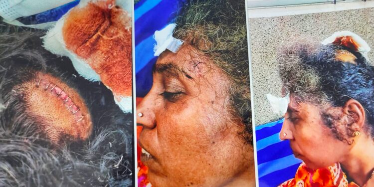 ಜಮೀನು ವಿಚಾರವಾಗಿ ಜಿ. ಪಂ. ಮಾಜಿ ಸದಸ್ಯನಿಂದ ಮಹಿಳೆಯ ಮೇಲೆ ಕತ್ತಿಯಿಂದ ಹಲ್ಲೆ: ತನ್ನ ರಾಜಕೀಯ ಪ್ರಬಲತೆಯಿಂದ ಪೊಲೀಸರನ್ನು ಕೈವಶ ಮಾಡಿಕೊಂಡಿರುವ ಆರೋಪ:; ನ್ಯಾಯ ಒದಗಿಸಿ ಕೊಡುವಂತೆ ಸಂತ್ರಸ್ತ ಮಹಿಳೆಯಿಂದ ಮನವಿ