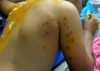 ಬಂಟ್ವಾಳ: ಕಣಜದ ಹುಳು ದಾಳಿ: ಗಂಭೀರ ಗಾಯಗೊಂಡ ಬಾಲಕ ಮೃತ್ಯು..!!!