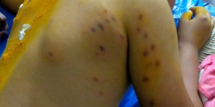 ಬಂಟ್ವಾಳ: ಕಣಜದ ಹುಳು ದಾಳಿ: ಗಂಭೀರ ಗಾಯಗೊಂಡ ಬಾಲಕ ಮೃತ್ಯು..!!!