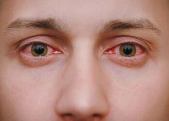 ಕರಾವಳಿಯಲ್ಲಿ ಮದ್ರಾಸ್ ಐ ಹಾವಳಿ : ನಿತ್ಯ 100ಕ್ಕೂ ಹೆಚ್ಚು ಮಂದಿಗೆ ವೈರಸ್..!!