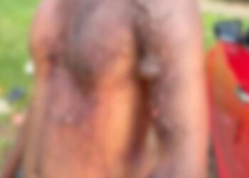 ಉಡುಪಿ : ಗಂಡನಿಗೆ ಮೆಣಸಿನ ಹುಡಿ ಮಿಶ್ರಿತ ಬಿಸಿನೀರು ಎರಚಿದ ಪತ್ನಿ..!!!