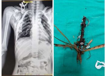 ಮಂಗಳೂರು : ಬಾಲಕನ ಎದೆಯಿಂದ ಮರದ ತುಂಡು ಹೊರತೆಗೆದ ವೆನ್ಲಾಕ್‌ ವೈದ್ಯರ ತಂಡ..!!