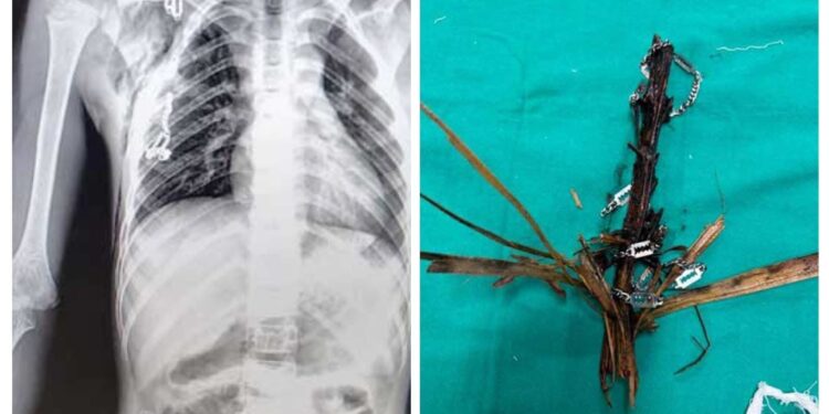 ಮಂಗಳೂರು : ಬಾಲಕನ ಎದೆಯಿಂದ ಮರದ ತುಂಡು ಹೊರತೆಗೆದ ವೆನ್ಲಾಕ್ ವೈದ್ಯರ ತಂಡ..!!