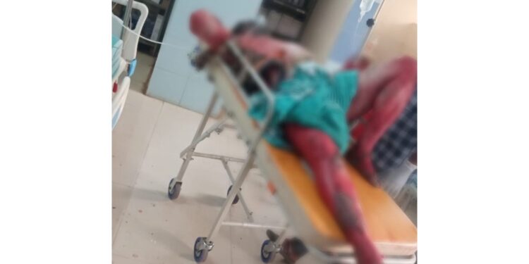 ಬೆಂಕಿ ಹಚ್ಚಿ ಆತ್ಮಹತ್ಯೆಗೆ ಯತ್ನಿಸಿದ್ದ ವ್ಯಕ್ತಿ ಚಿಕಿತ್ಸೆ ಫಲಕಾರಿಯಾಗದೆ ಸಾವು.!!